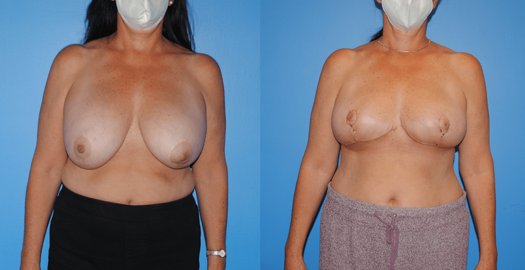Oncoplastic-Reconstruction-and-Implant-Removal-Breast-Cancer-Lumpectomy