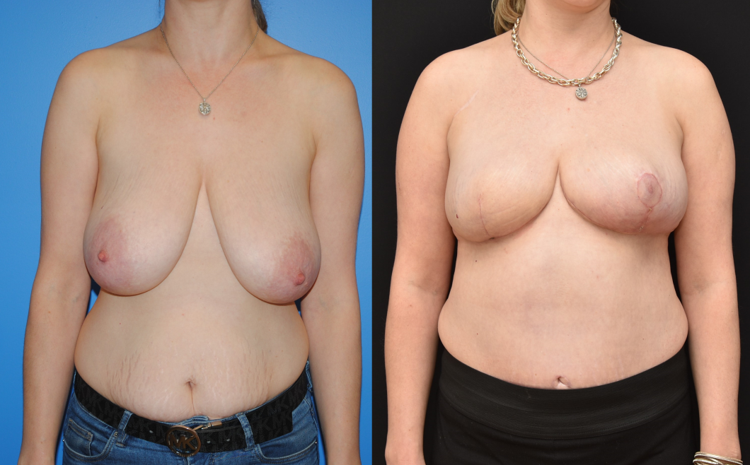 Right-Breast-DIEP-Flap-Breast-Reconstruction.-Breast-Reconstruction-Following-Mastectomy