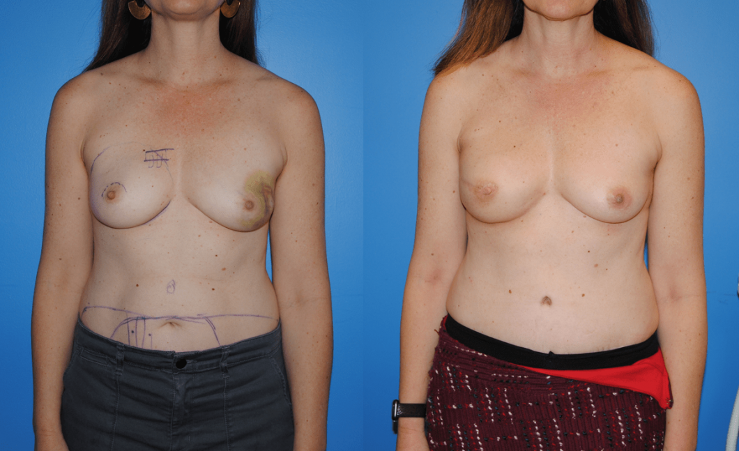 Right-Breast-DIEP-Flap-Breast-Reconstruction