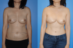 1_DIEP-Flap-Breast-Reconstruction