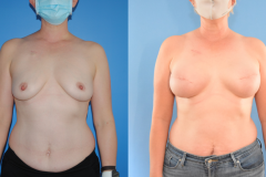 1_Implant-Breast-Reconstruction