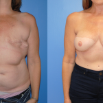 3D-Tatoo-DIEP-Breast-Reconstruction