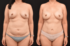 Bilateral-DIEP-Flap-Breast-Reconstruction-Brian-Dickinson-M.D.-BRCA-1-Prophylactic-Mastectomy