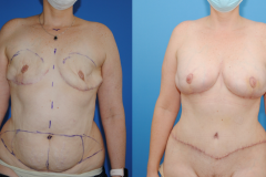 Bilateral-DIEP-Flap-Breast-Reconstruction-Brian-Dickinson-M.D.