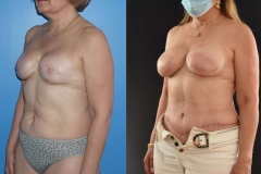 Bilateral-DIEP-Flap-Breast-Reconstruction-Removing-Implants-and-Replacing-with-Bilateral-DIEP-Flaps-Breast-Cancer-Reconstruction