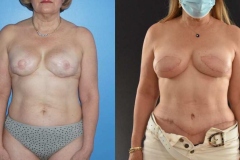 Bilateral-DIEP-Flap-Breast-Reconstruction-Removing-Implants-and-Replacing-with-Bilateral-DIEP-Flaps