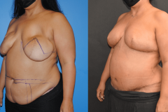 Bilateral-DIEP-Flap-Breast-Reconstruction-after-Implant-Removal-Brian-P.-Dickinson-M.D.