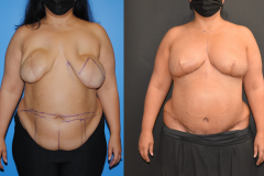 Bilateral-DIEP-Flap-Breast-Reconstruction-after-Implants-Brian-P.-Dickinson-M.D.
