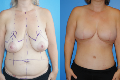 Bilateral-DIEP-Flap-Reconstruction-Brian-Dickinson-M.D.-Newport-Beach