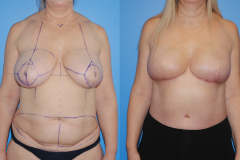 Bilateral-DIEP-flap-reconstruction-for-Bilateral-Mastectomy