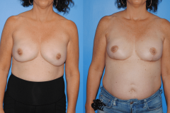 Bilateral-Implant-Based-Breast-Reconstruction