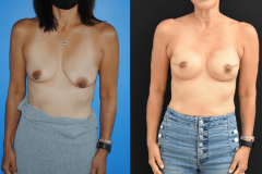 Bilateral-Mastectomy-Implant-Reconstruction-Copy