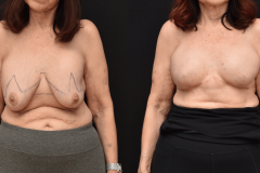 Bilateral-Mastectomy-Reconstruction-Brian-P.-Dickinson-M.D.-Newport-Beach-CA