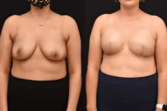 Bilateral-Mastectomy-Reconstruction-scaled