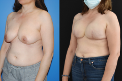 Bilateral-Mastectomy-Recoonstruction-Expander-Implant-Reconstruction-Three-Quarter-View