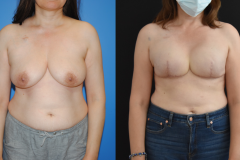 Bilateral-Mastectomy-Recoonstruction-Expander-Implant-Reconstruction