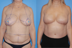 Breast-Cancer-Awareness-Month-Bilateral-DIEP-Flap-Complete-Burried-Flap-scaled