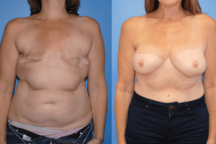 Breast-Cancer-Awareness-Month-Bilateral-DIEP-Flap-Reconstruction-and-3D-Nipple-Areola-Complex-Tatto-scaled