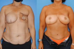 Breast-Cancer-Awareness-Month-Left-Breast-DIEP-Flap-Reconstruction-and-3D-Nipple-Areola-Complex-Tattoo-scaled