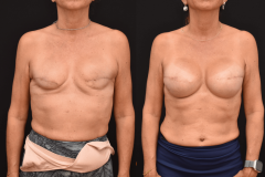 Breast-Cancer-Awareness-Month-October-Breast-Cancer-Reconstruction-scaled