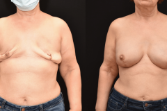 Breast-Implant-Reconstruction-Following-Bilateral-Mastectomy