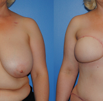 Breast Reconstruction with autologous tissue