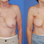 Breast Reconstruction TRAM Flap