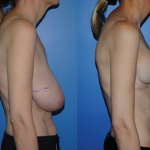 Breast Reconstruction Wise Pattern Newport Beach