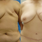 Breast Reconstruction with DIEP Flaps