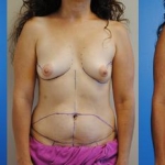 Early Post-Operative Bilateral DIEP Breast Reconstruction