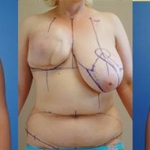 DIEP Flap Breast Reconstruction by Dr. Dickinson in Newport Beach