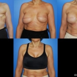 Silicone Breast Implant Breast Reconstruction in Newport Beach