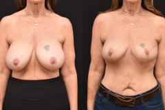CE-Oncoplastic