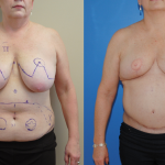 DIEP-Bilateral-Flap-Following-Mastectomy