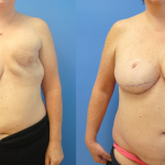 DIEP-Flap-Breast-Reconstruction-1