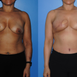 DIEP-Flap-Breast-Reconstruction