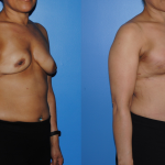 DIEP-Flap-Breast-Reconstruction-Oblique-Breast-Reconstruction