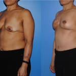 DIEP-Flap-Breast-Reconstruction-Oblique