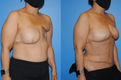 DIEP-Flap-Breast-Reconstruction-Post-Radiation-Therapy-Newport-Beach-Brian-Dickinson