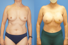 DIEP-Flap-Breast-Reconstruction-and-Implants