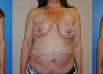 DIEP Flap Breast Reconstruction following mastectomy