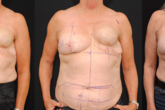 DIEP-Flap-Flight-Plan-Breast-Reconstruction