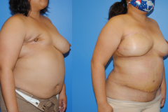 DIEP-Flap-Reconstrcution-after-Mastectomy-and-Radiation-Therapy-Oblique-Photo