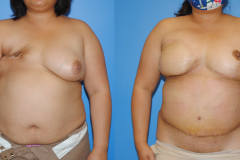 DIEP-Flap-Reconstrcution-after-Mastectomy-and-Radiation-Therapy