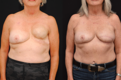 DIEP-Flap-Reconstruction-Left-Breast-Delayed-Reconstruction-Brian-P.-Dickinson-M.D.