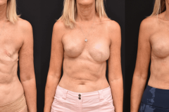 Delayed-Breast-Reconstruction-with-Implants-Right-Side-Whole-Breast-Left-SIDE-IORT-scaled