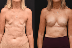 Delayed-Implant-Breast-Reconstruction-scaled
