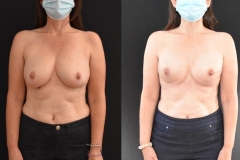 Implant-Breast-Reconstruction-Tissue-Expanders-to-Implants-1