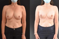 Implant-Breast-Reconstruction-Tissue-Expanders-to-Implants-Copy