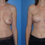 Implant Breast Reconstruction